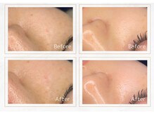 セレーノ 横浜(seReno)/純粋レチノールピールビフォアフ