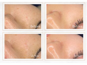 セレーノ 横浜(seReno)/純粋レチノールピールビフォアフ