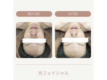 ミスミセス(Miss.Mrs)/光フェイシャルメニュー