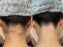 エピア 西尾店(Epia)/【脱毛】うなじ　シェービング付