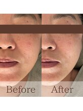 凪眠/ラジオ波ケアでたるみ改善