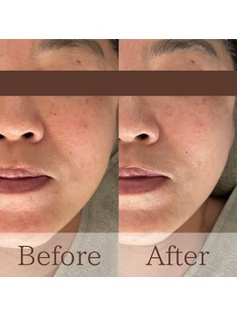 凪眠/ラジオ波ケアでたるみ改善