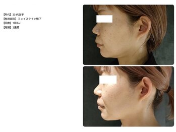 ラネージュ/レモンボトル3回フェイスライン