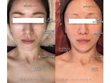 ルーチェスト(Lucest)の雰囲気（たるみ・ほうれい線が気になるお客様の変化。小顔フェイシャル）