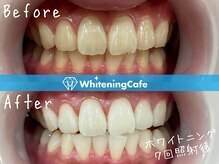 ホワイトニングカフェ赤羽店/ホワイトニングビフォーアフター