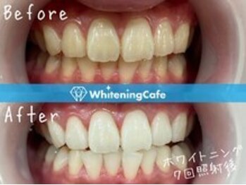 ホワイトニングカフェ赤羽店/ホワイトニングビフォーアフター
