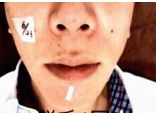 NTエステティック 西条店/メンズヒゲ3000円！