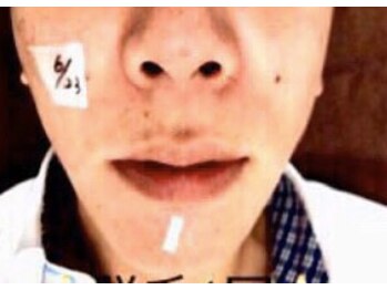 NTエステティック 西条店/メンズヒゲ3000円！