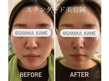 ぶんのいち整体院/美容鍼で頬スッキリリフトアップ