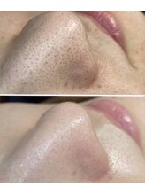 リリー 岐阜店(Lily)/人気の毛穴ケア