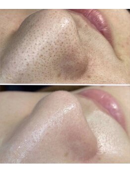 リリー 岐阜店(Lily)/人気の毛穴ケア