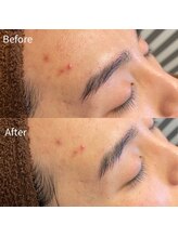 ビトタン 倉敷本店(+美to鍛)/ハーブピーリング1g/1回