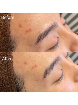 ビトタン 倉敷本店(+美to鍛)/ハーブピーリング1g/1回