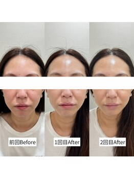 ラ クレール ビューティーサロン(LA CLAIR)/サーマリフトRF