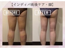 オキシー グレイス 小倉店(OXY Grace)/【インディバ術後ケア・脚】