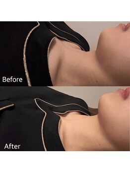 アエ メゾン(ae maison)/【脂肪分解剤導入】スッキリ小顔