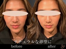 チョコバリ 郡山店(chocobari)/小顔×リフトアップ(美容鍼)20代