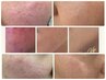 半額♪【ステロイド肌・敏感肌・赤ら顔の改善】特許スピキュールダイヤモンド