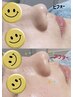 【学割U24】角質毛穴洗浄！ニキビケアに◎¥6980→¥3980