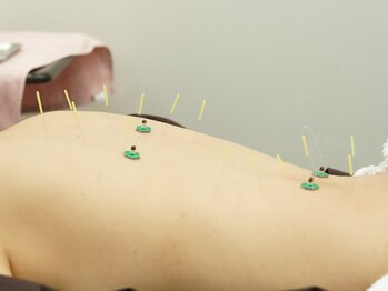 アキュピタル(acupital)の写真/冷え改善＆代謝UP！自律神経を整える鍼灸で、女性特有の体の不調を根本からケア☆