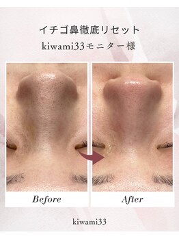 キワミ サーティスリー(kiwami33)の写真/美容液で毛穴を洗うハイドラ毛穴ピーリング★トルネード水流が毛穴に詰まった汚れをすっきりキレイに！