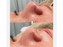 美助(bisuke)/水素ハイドロ毛穴洗浄コース１回