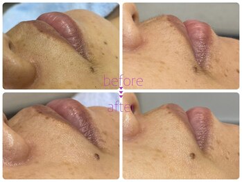 イサミ(ISAMI)/産毛ケアでトーンアップ