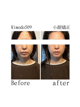 リモド(Rimodo509)/小顔矯正(ヘッドスパ