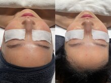 フロムミー 銀座本店(FROM ME)/ シャネル水光ピール