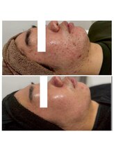 アトワ(A toi)/ハーブピーリング（棘あり）