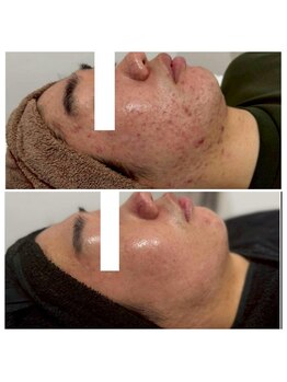 アトワ(A toi)/ハーブピーリング(棘あり)