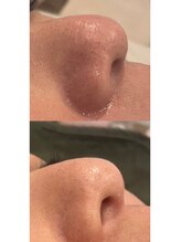 ハルユイ(haruyui)/毛穴洗浄