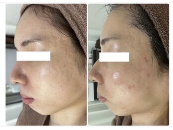 ホワイトアクア 北千住店(WHITE AQUA)/ハーブピーリング/肌質改善/毛穴