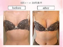 リール 恵比寿店(RIRE)/バストアップ症例【広尾恵比寿】