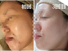 サロンドミミ(Salon de Mimi)の雰囲気（毛穴洗浄＆ハーブピーリング毛穴ニキビケア肌荒れレスな陶器肌へ）
