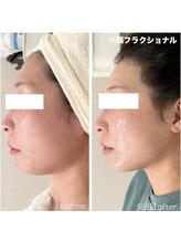 オルネ(ORNE.)/衝撃の結果！小顔フラクショナル