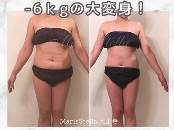 マリスステラ 天王寺(MarisStella)/短期間で-6kg【天王寺エステ】
