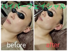 サロンドリドミ 新瑞橋店(Salon de ridomi)/ハイパーナイフ　フェイシャル