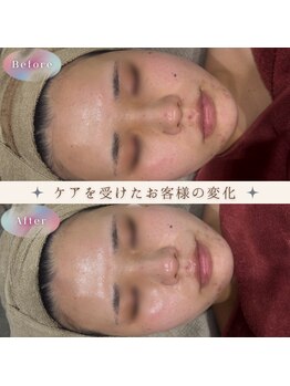 美肌研究所 絹 田辺店/1度で赤み改善*ハーブピーリング