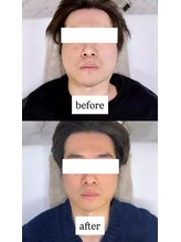 ルーツ 渋谷店(R∞ts)/浮腫・フェイスライン改善