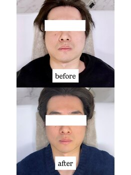ルーツ 渋谷店(R∞ts)/浮腫・フェイスライン改善