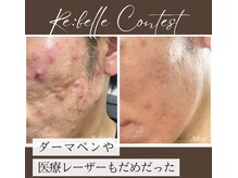 ブールドネージュ(Boule de Neige)/肌質改善リベルハーブピーリング