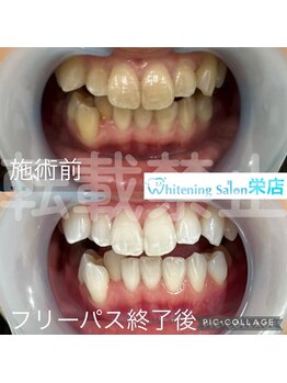 ホワイトニングサロン 名古屋 栄店/【ホワイトニング】