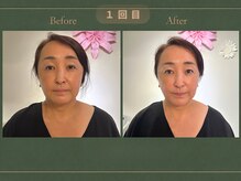 インヤン(yinyang)/40代後半｜たるみ症例