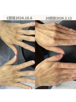 シェーングランツ(SchonGlanz)/手甲手指の症例