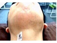 NTエステティック 西条店/ヒゲ脱毛3000円！