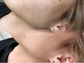 シルネ 三軒茶屋(Cilune)の写真/産毛＆角質を同時にケアすることで、つるんとした質感と透明感のある美しい素肌に♪