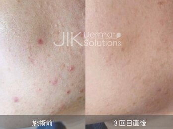 レディラックビューティー 横浜(Lady Luck beauty)/繰り返す肌荒れにダクトピール★