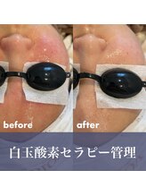 シルク(Silk)/白玉酸素セラピー管理
