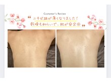 ブリス 渋谷駅前(BliSS)/ハーブピーリング|背中の肌荒れ